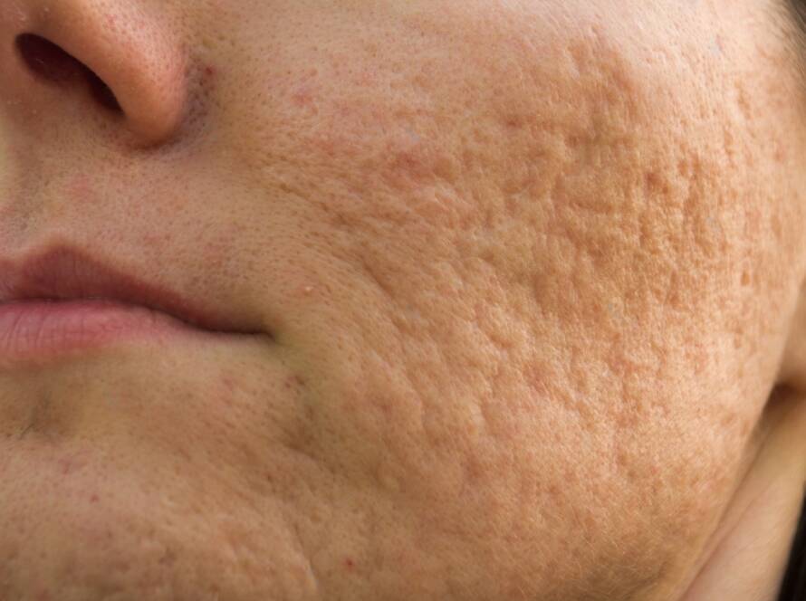 acne scars