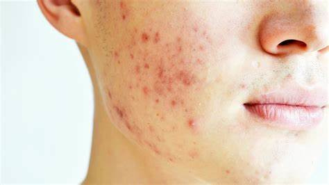 acne scare
