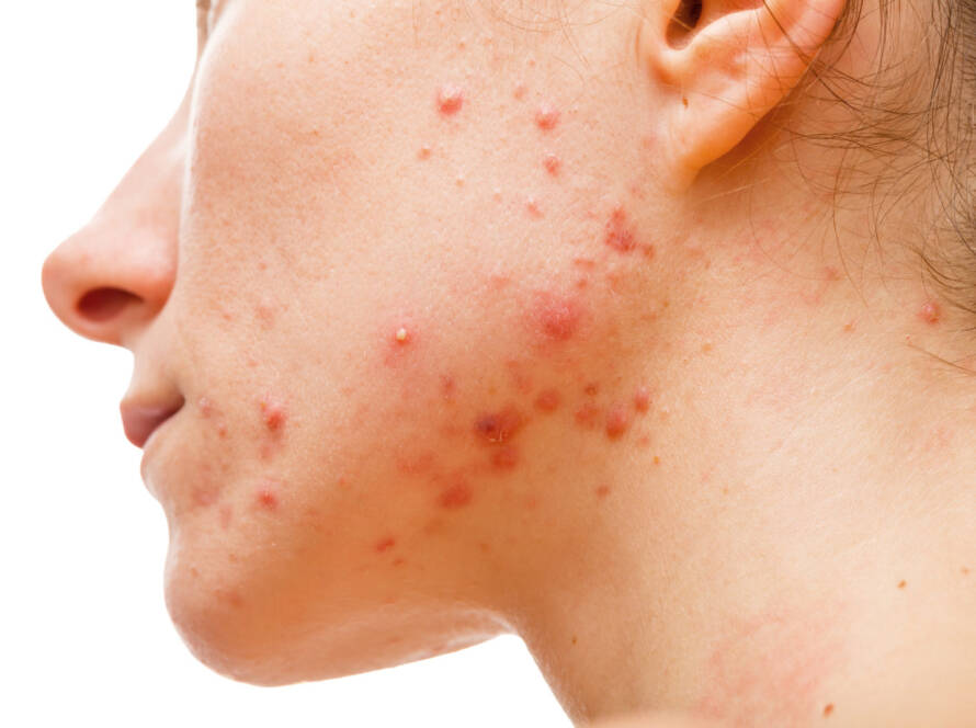 Clear Severe Acne