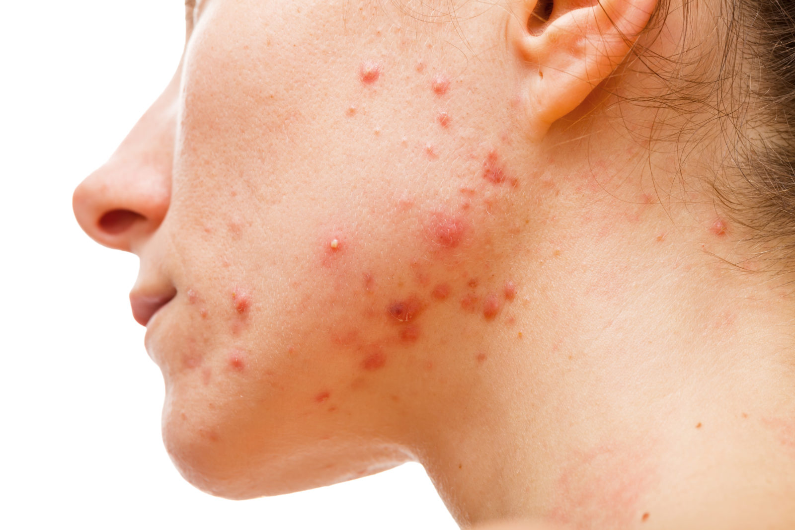 Clear Severe Acne