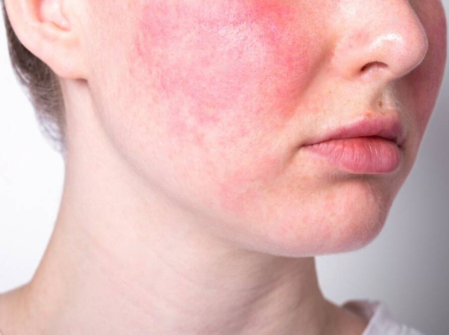 rosacea