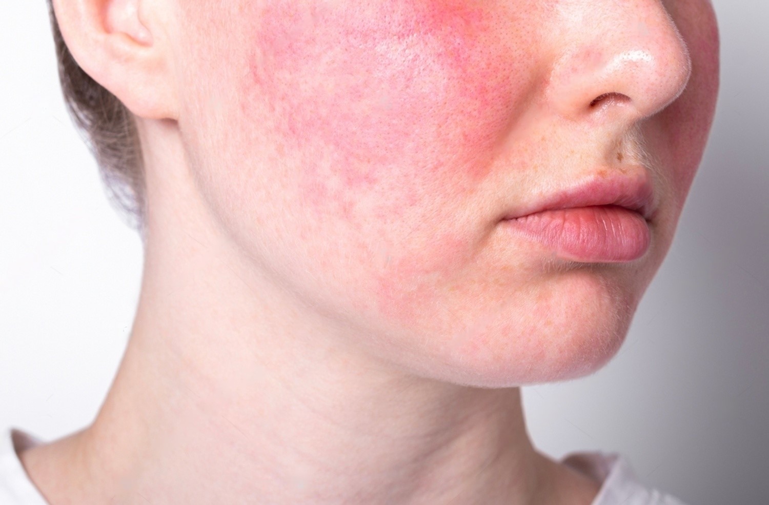 rosacea